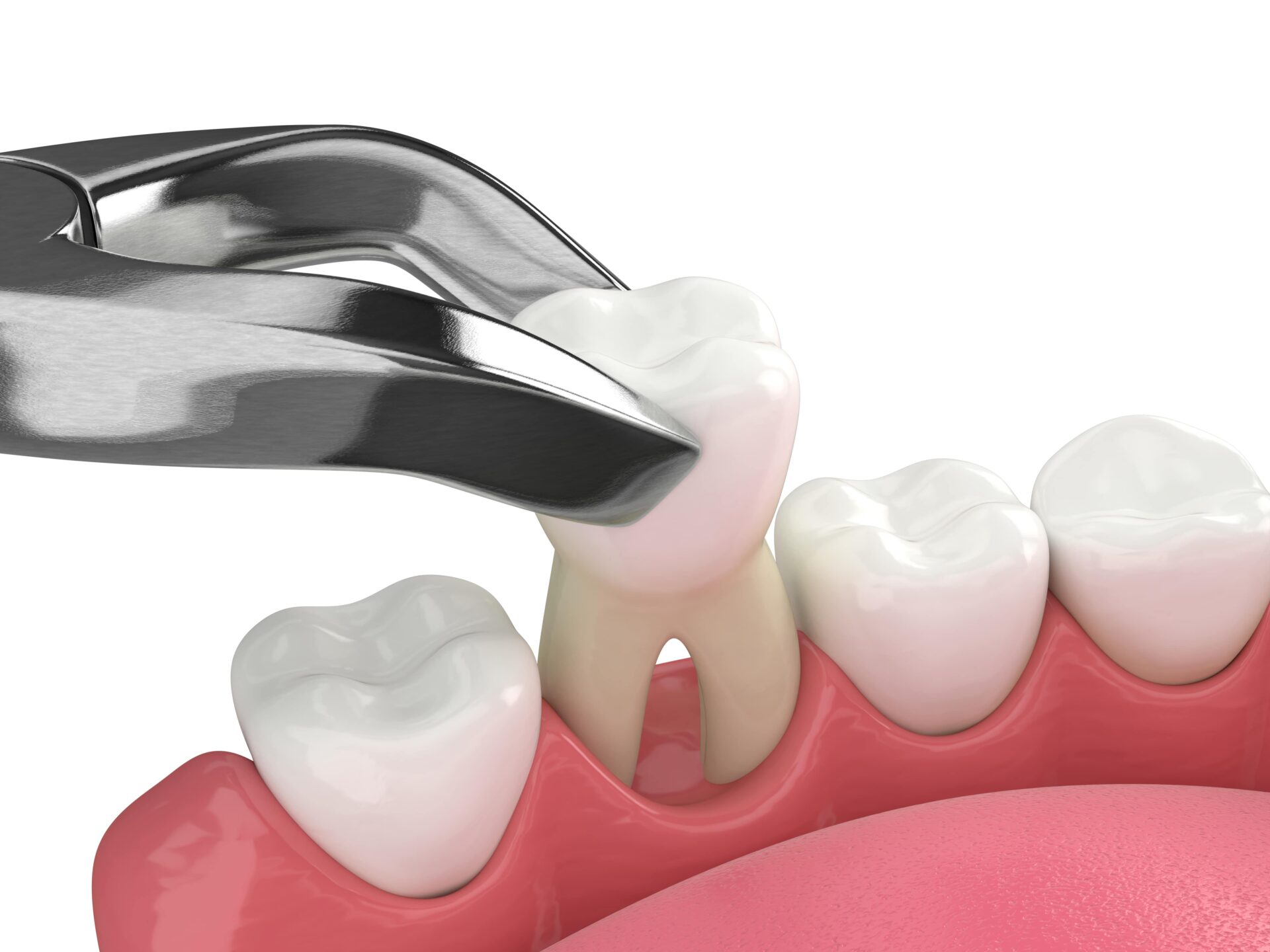Tooth Extraction Overview